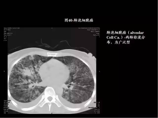 為什么做胸、腹部CT掃描時(shí)需要吸氣-屏氣-吐氣？